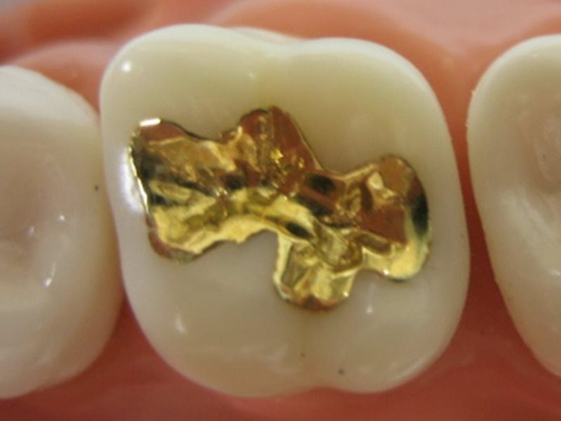 inlay